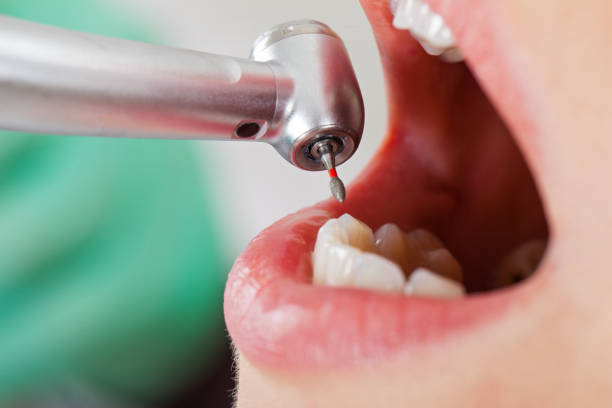 Best Emergency Root Canal Treatment in Manning, IA